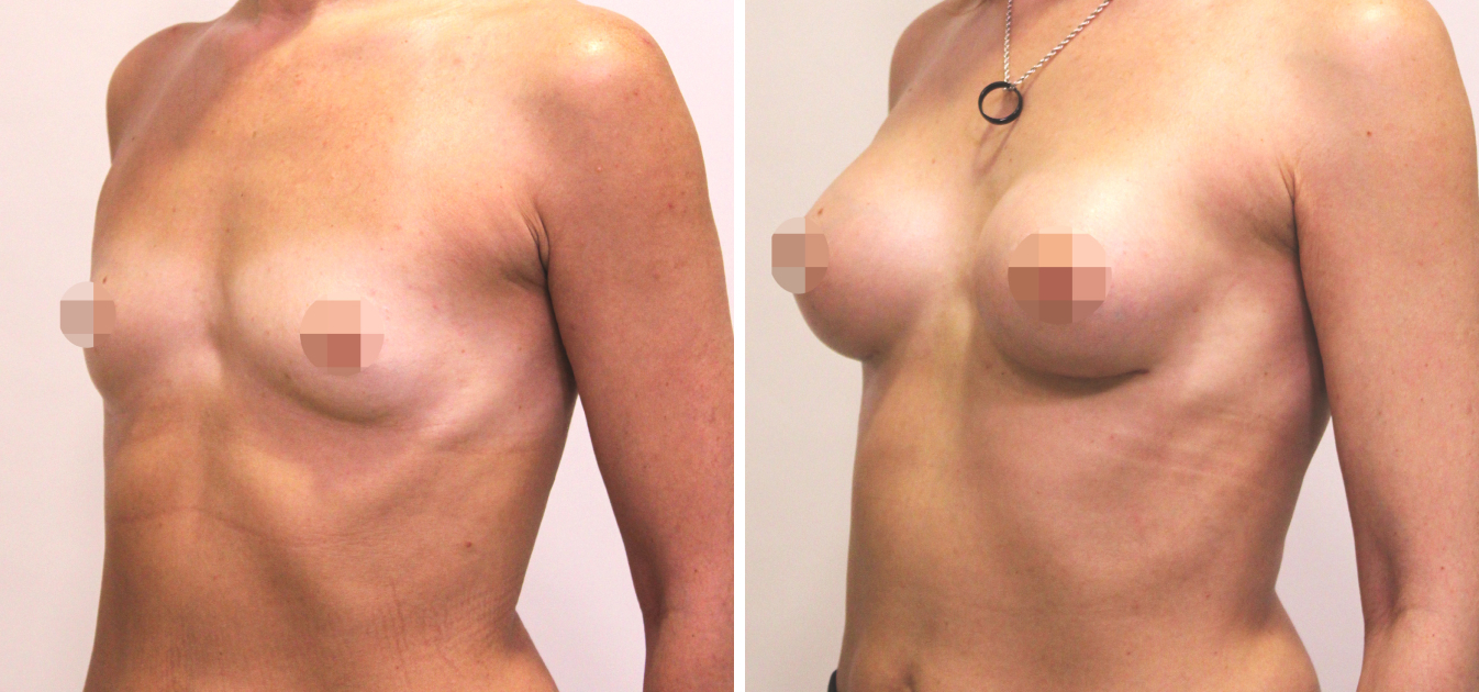 Фоторезультаты: увеличение груди до и после изображение 20