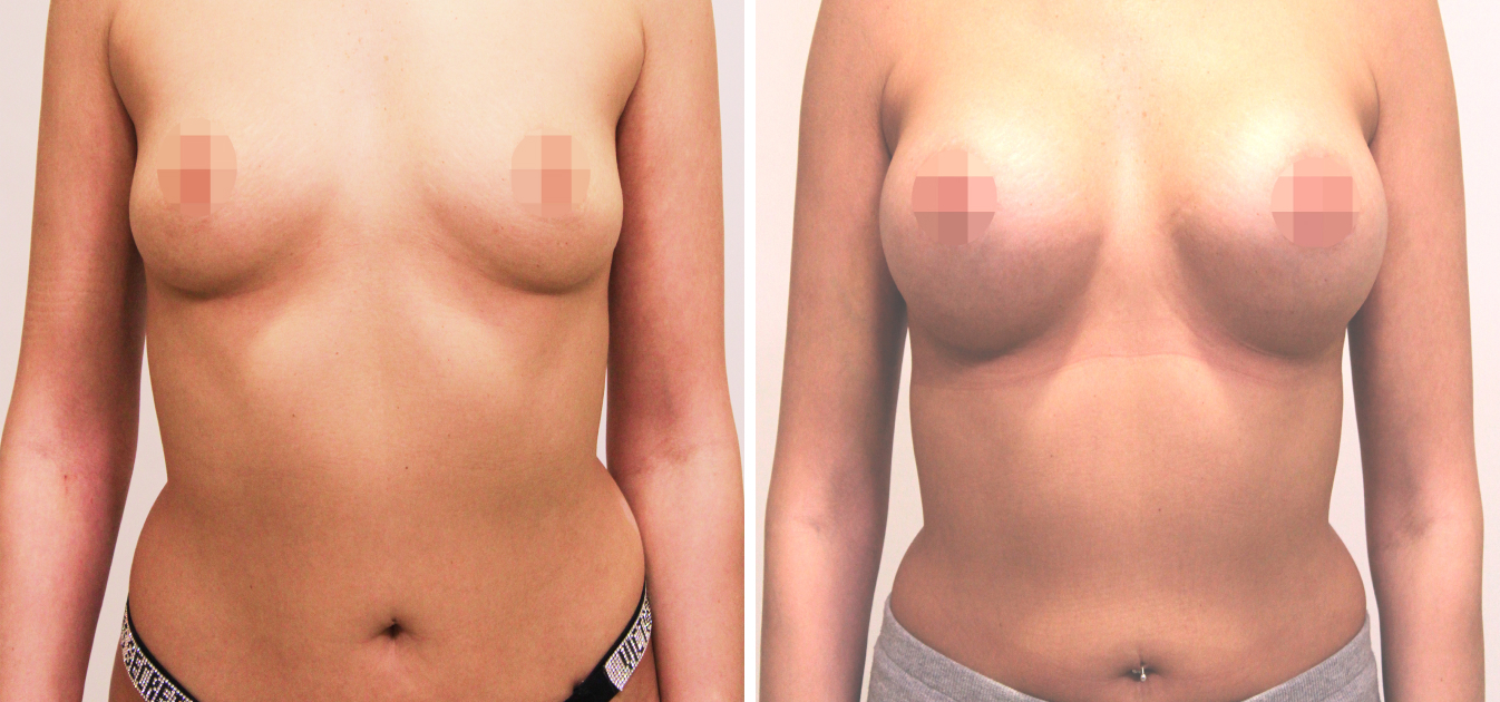 Фоторезультаты: увеличение груди до и после изображение 19