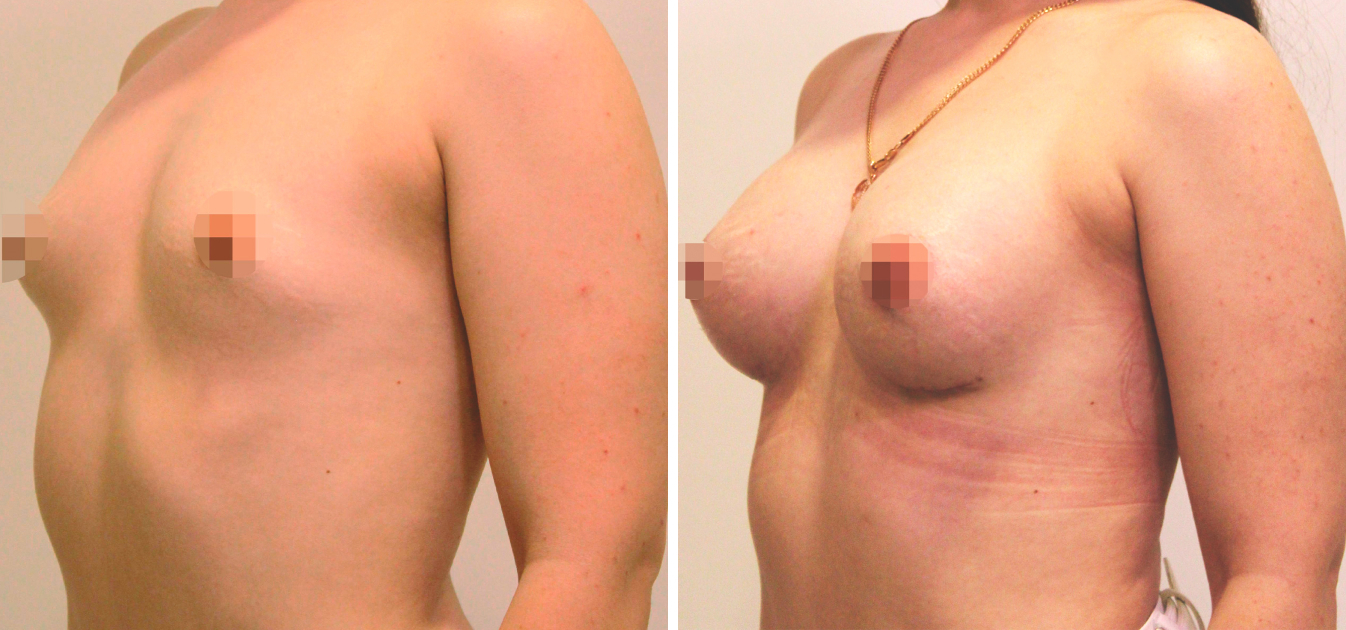 Фоторезультаты: увеличение груди до и после изображение 18