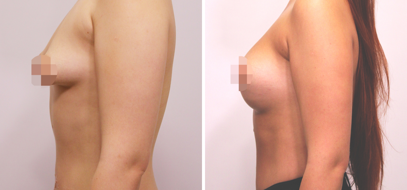 Фоторезультаты: увеличение груди до и после изображение 25