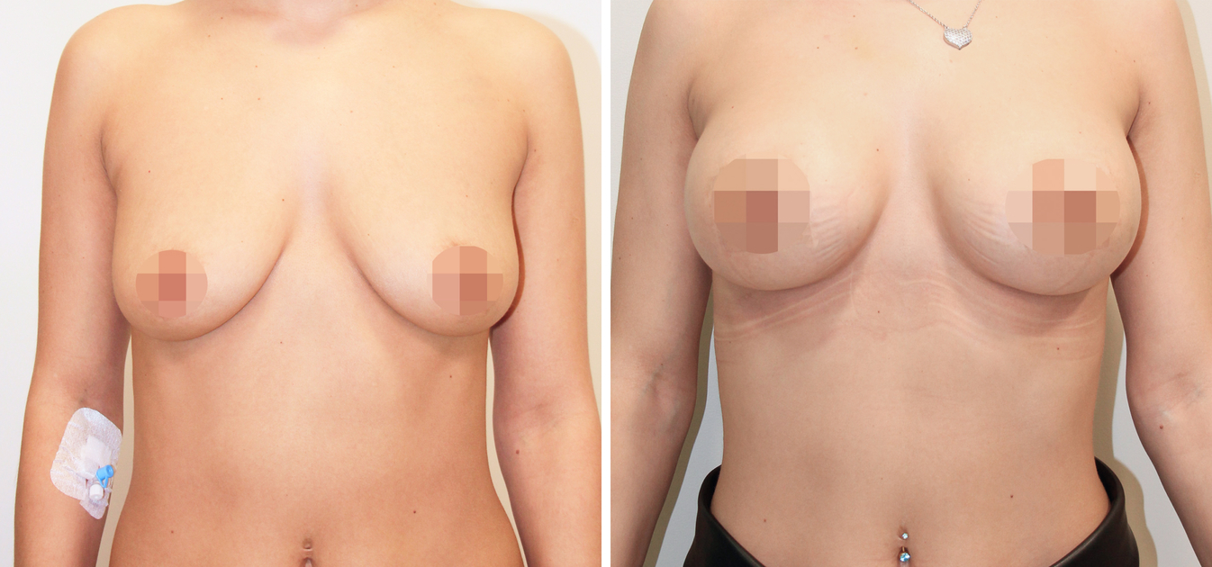 Фоторезультаты: увеличение груди до и после изображение 22