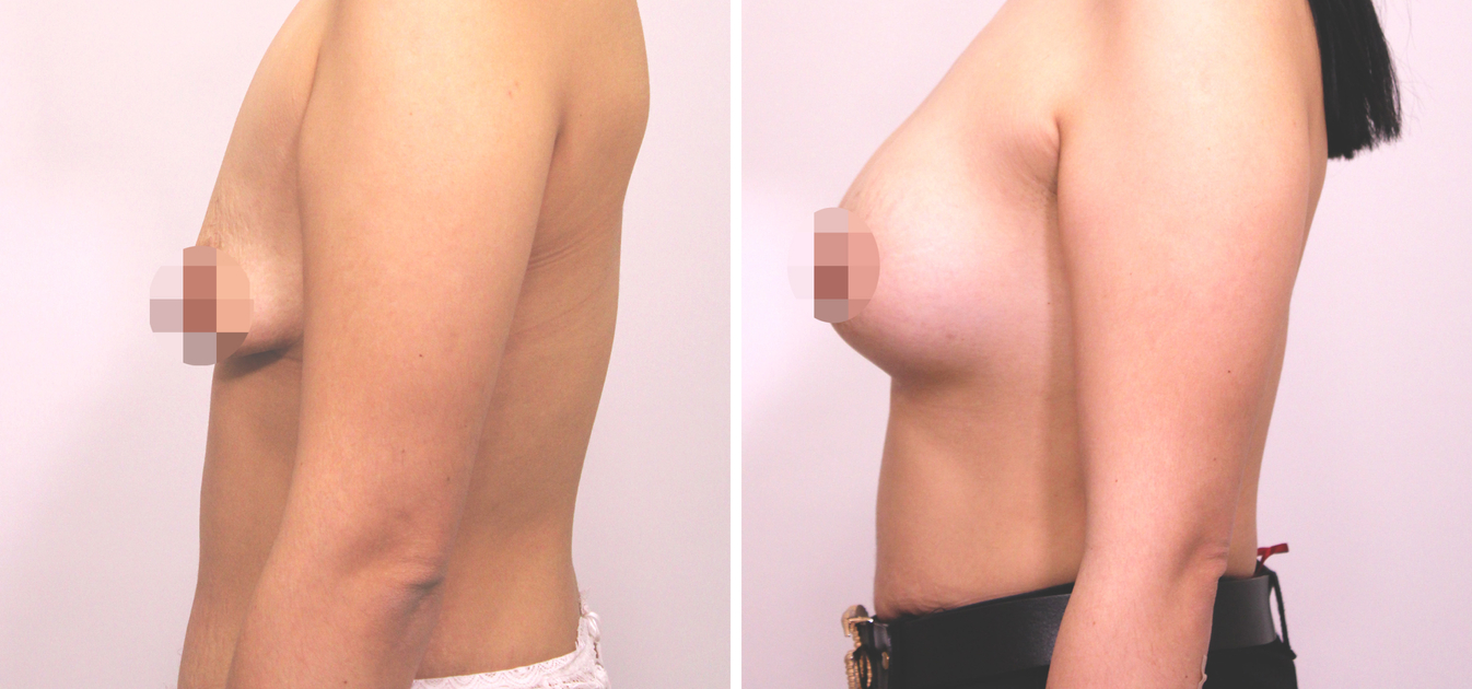 Фоторезультаты: увеличение груди до и после изображение 23