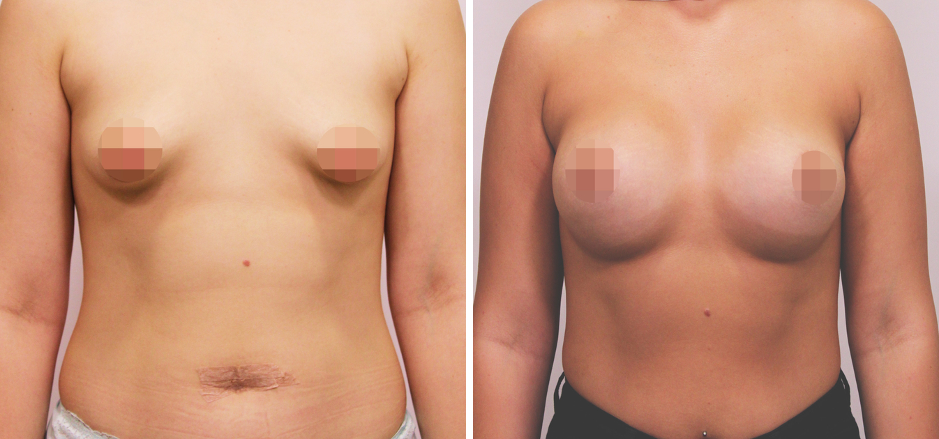 Фоторезультаты: увеличение груди до и после изображение 24