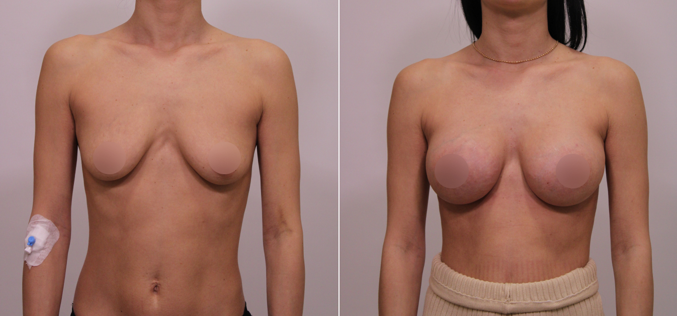 Фоторезультаты: увеличение груди до и после изображение 13